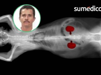 Insuficiencia renal, enfermedad que tenía "El Mencho"