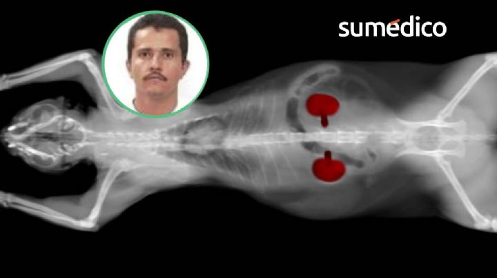 Insuficiencia renal, enfermedad que tenía "El Mencho", abatido por el Ejército