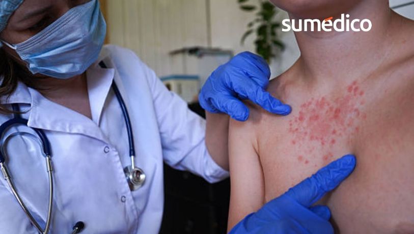 Sarampión: qué hacer cuando ya tienes la infección