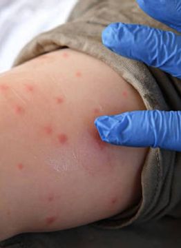 Foto descriptiva de: Vacunación, clave para frenar el sarampión y evitar regreso de otras enfermedades: especialistas