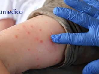 Vacunación, clave para frenar el sarampión y evitar regreso de otras enfermedades: especialistas