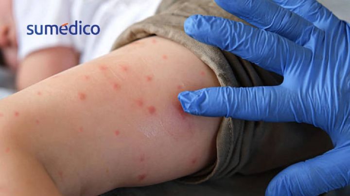 Vacunación, clave para frenar el sarampión y evitar regreso de otras enfermedades: especialistas