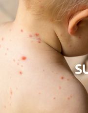 Foto descriptiva de: Expertos advirtieron caída en vacunación contra sarampión desde 2022