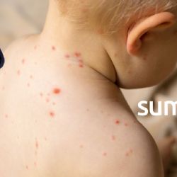 Expertos advirtieron caída en vacunación contra sarampión desde 2022