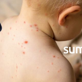 Expertos advirtieron caída en vacunación contra sarampión desde 2022