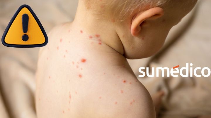 Expertos advirtieron caída en vacunación contra sarampión desde 2022