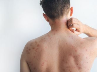 Sordera, el riesgo poco conocido del sarampión 