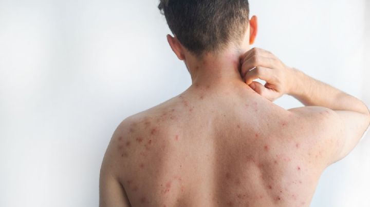 Sordera, el riesgo poco conocido del sarampión 