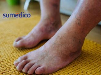 Diabetes: cómo cuidar tus pies y evitar complicaciones