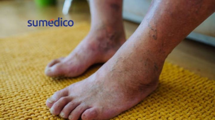 Diabetes: cómo cuidar tus pies y evitar complicaciones