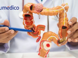 ¿Cómo protegerte del cáncer colorrectal?