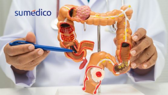 ¿Cómo protegerte del cáncer colorrectal?