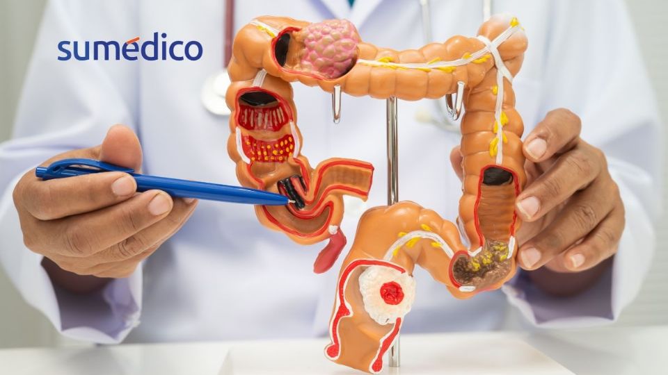 Descubre cómo protegerte del cáncer colorrectal