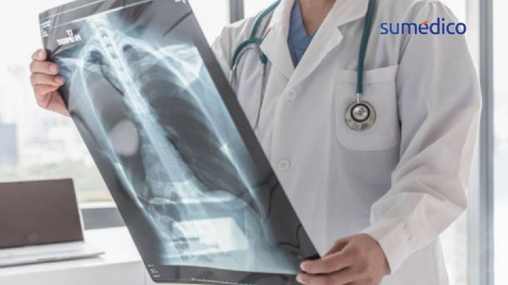 Tuberculosis: fallas en detección mantienen los contagios