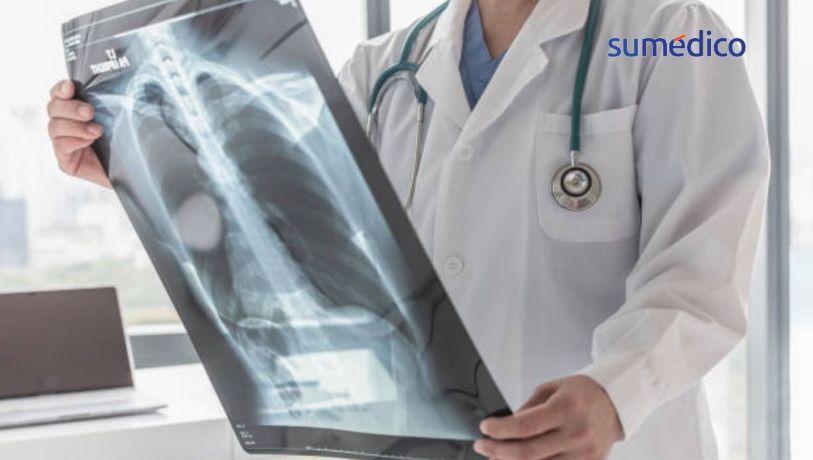 Tuberculosis: fallas en detección mantienen los contagios