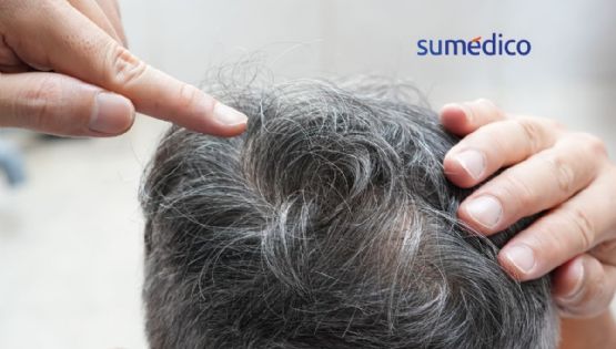 ¿A partir de qué edad es normal la aparición de las canas?