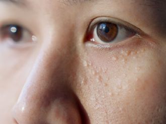 Granitos blancos alrededor de los ojos: ¿Qué son y por qué salen? 