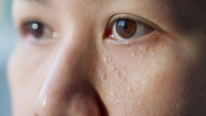 Granitos blancos alrededor de los ojos: ¿Qué son y por qué salen? 