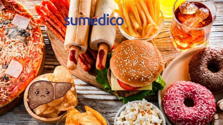¿Tienes hígado graso? Estos son los alimentos que NO debes comer