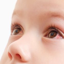 Ojo rojo y fiebre: una alerta temprana de sarampión