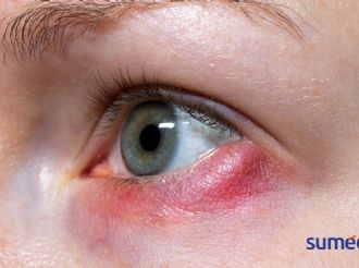 ¿Qué son los orzuelos en el ojo y cómo tratarlos?