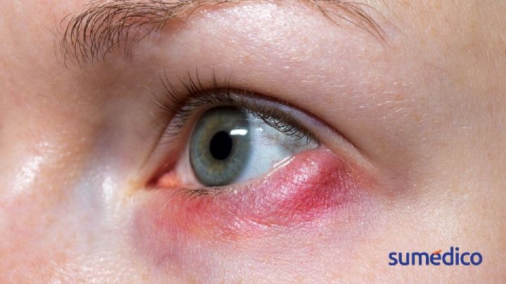 ¿Qué son los orzuelos en el ojo y cómo tratarlos?