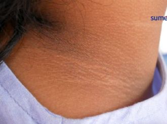 Así se ve la resistencia a la insulina en la piel