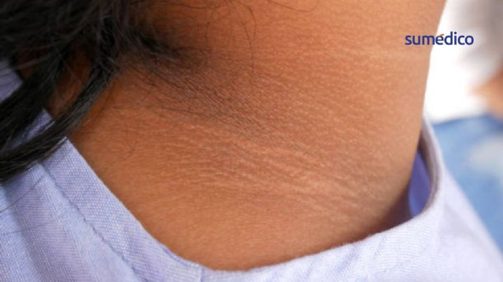 Así se ve la resistencia a la insulina en la piel