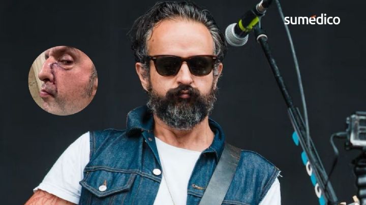 ¿Qué le pasó a Tito Fuentes de Molotov?