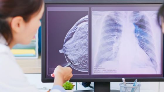 Nuevo protocolo nacional contra el cáncer de mama