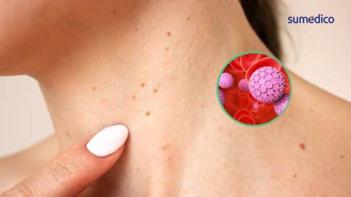 El virus silencioso que puede acabar en cáncer