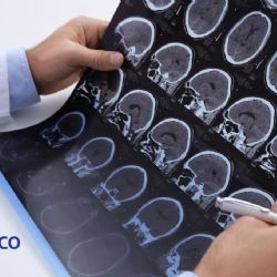 Esclerosis múltiple: la enfermedad que puede tardar hasta 10 años en ser diagnosticada