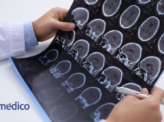 Esclerosis múltiple puede tardar hasta 10 años en ser diagnosticada