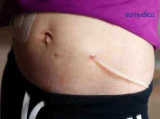 Diabetes eleva el riesgo de daño renal en México