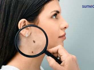 5 señales que indican cáncer de piel y que NO debes de ignorar