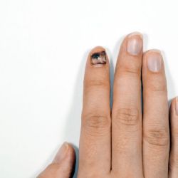 Melanoma subungueal: El peligroso cáncer de piel bajo la uña