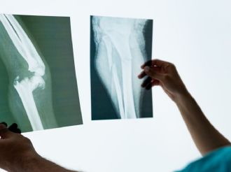  La enfermedad silenciosa que acecha tras la menopausia prematura