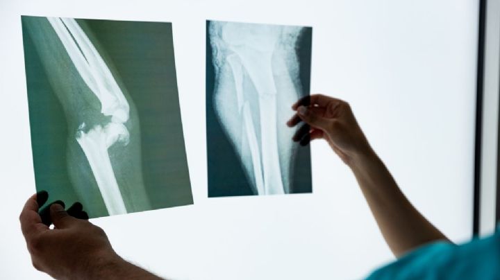  La enfermedad silenciosa que acecha tras la menopausia prematura