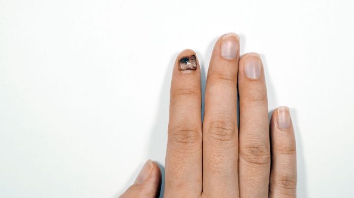 Melanoma subungueal: El peligroso cáncer de piel bajo la uña