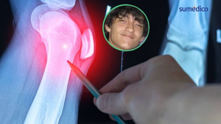 “Si es necesario que me corten la pierna, córtamela; mi vida es primero”: Alex enfrenta a los 17 años cáncer de hueso