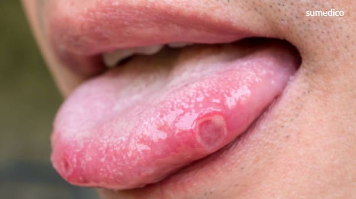 ¿El bicarbonato de sodio cura heridas en la boca? Esto dicen los especialistas