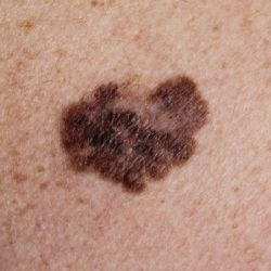 El melanoma que más afecta a los mexicanos y que no es por el sol