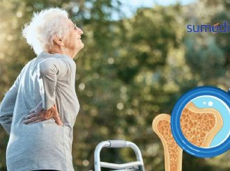 ¿Qué es la osteoporosis y por qué es fundamental prevenirla?