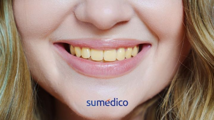 ¿Qué causa que los dientes se pongan amarillos?