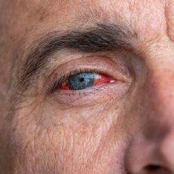Vasculitis ocular: cuando los vasos del ojo se inflaman