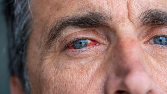Vasculitis ocular: cuando los vasos del ojo se inflaman