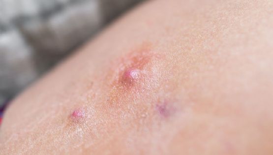 ¿Qué son los golondrinos? La enfermedad de la piel que suele confundirse