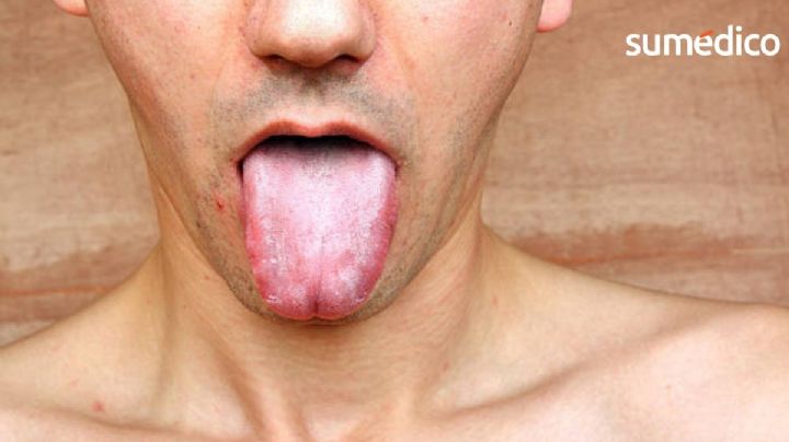 ¿Se te duerme la lengua? 5 enfermedades que podrían causarlo