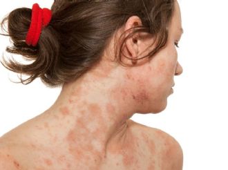 ¿Qué provoca la dermatitis atópica?