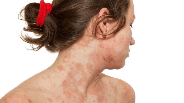 ¿Qué provoca la dermatitis atópica?